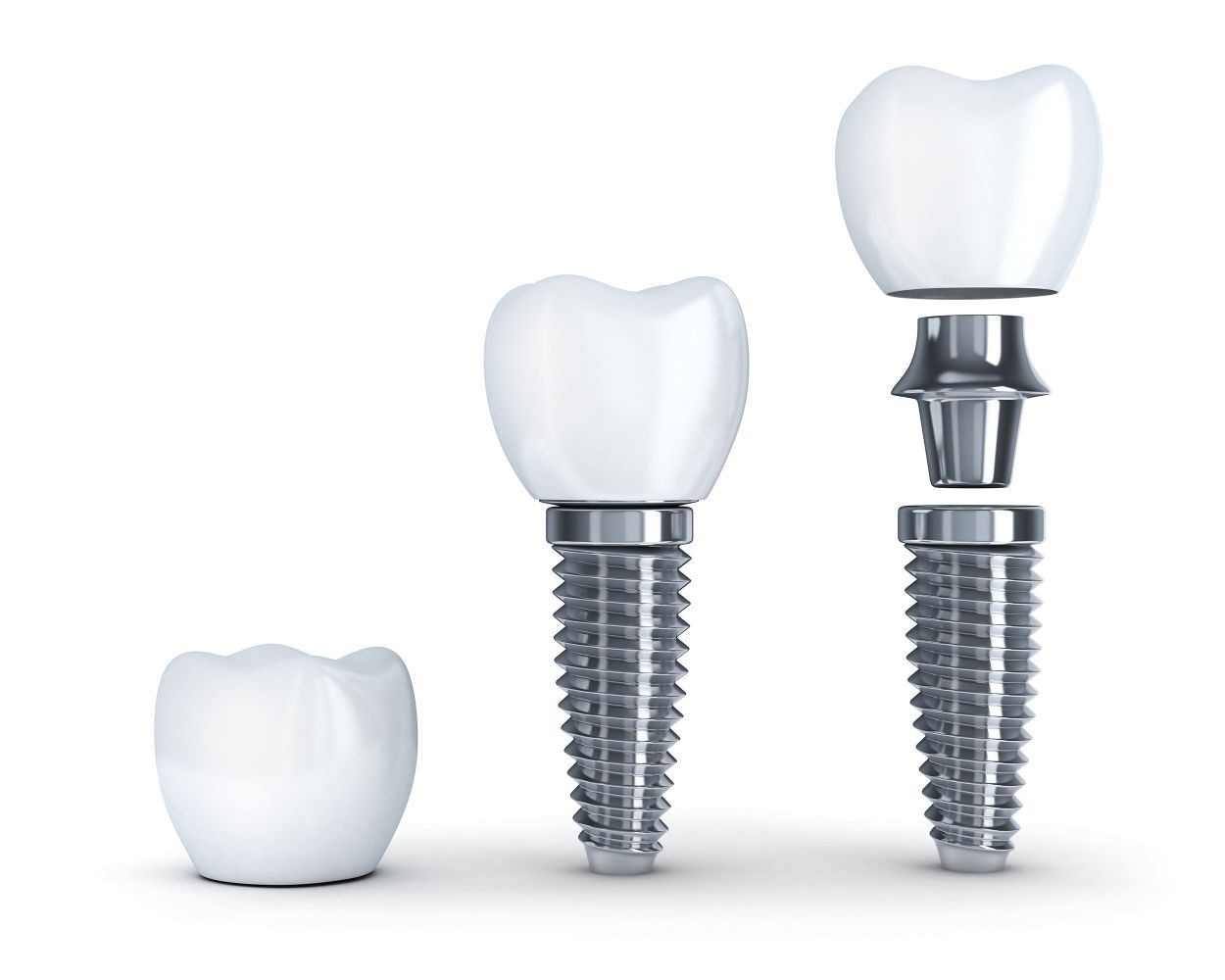Dentist explaining dental implant procedure to patient at Chalkwell Dental Practice